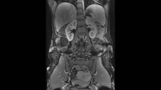 MDI Radiology  MRI Abdomen Coronal Views [upl. by Giralda646]