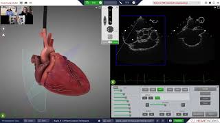 TEE Transeptal Online Training [upl. by Afatsom]