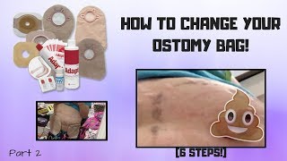 HOW TO CHANGE YOUR OSTOMY BAG Part 2 [upl. by Edurtreg765]