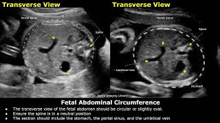 How To Measure Fetal Abdominal Circumference AC On Ultrasound  Fetal Biometry  Obstetric USG [upl. by Twum]