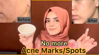 How To Remove Acne Marks Or Spots  Best Easy Home Remedy For Acne  Dietitian Aqsa [upl. by Labanna]