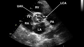 Unicuspid Aortic Valve [upl. by Morita604]