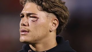 NRL News Reece Walsh Eye injury [upl. by Jaclyn263]