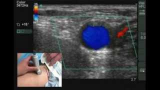 Ultrasound guided Nerve block and Cannulation  Tutorial [upl. by Nwahsav]