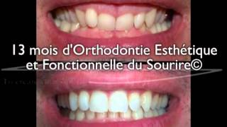 Sourire gingival adulte  correction en 13 mois par aligneurs® en OEFS© [upl. by Barvick440]