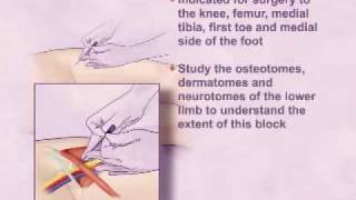 Single Injection Femoral Nerve Block [upl. by Nnahgiel114]