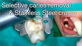 Selective caries removal amp stainless steel crown [upl. by Sello]