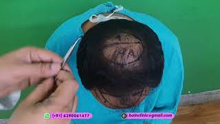 Hair Transplant Planing and Marking  Dr Jayanta Bain Plastic and cosmetic Surgeon  Kolkata [upl. by Remat]