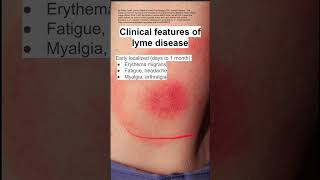 Clinical features of lyme disease [upl. by Ahrat]