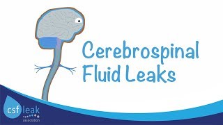 An Introduction to Cerebrospinal Fluid CSF Leaks [upl. by Norton465]