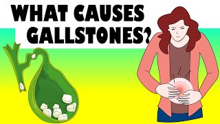 What Causes Gallstones Major Causes Of Gallstone Disease Gallstones Causes [upl. by Trelu951]