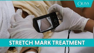 How To Remove Stretch Marks With Pixel Laser Resurfacing amp MNRF Treatments [upl. by Blodget501]