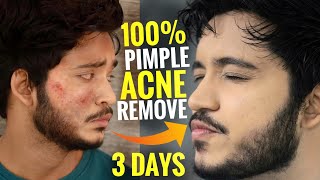 How To Remove Pimples FAST  100 Acne Removal Guarantee  Acne amp Pimples Removal At HOME [upl. by Newton]