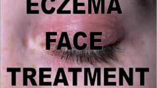 How To Treat Exzema Face  Exzema Face Remedies [upl. by Bethel]