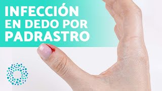 ¿Cómo CURAR Un PADRASTRO INFECTADO 😟 Padrastro Infectado Tratamiento [upl. by Jilleen]