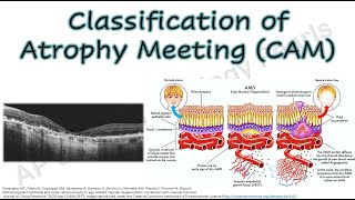 Classification of Atrophy Meeting Reports  Macular Atrophy in AMD  Geographic Atrophy [upl. by Asiole]