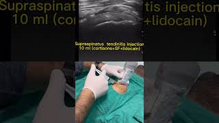 Subacromial impingement syndrome [upl. by Latsyrd]