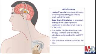 Surgical Treatment For Parkinsons Disease [upl. by Enaxor]