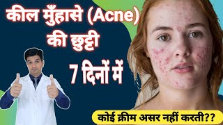 Pimple गायब हो जाएंगे  Adapalene clindamycin gel  Cream for Acne and Pimple [upl. by Aynekat695]