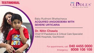 Successful Treatment of Acquired Angioedema and Severe Urticaria  KIMS Cuddles Gachibowli [upl. by Ecreip]