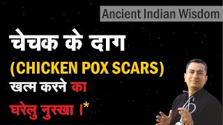 CHICKEN POX SCARS II An ancient Indian natural DIY homemade remedy II Dr Umang Khanna [upl. by Oderfla]