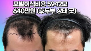 모발이식비용 절개 비절개 혼용 5000모 640만원 비용으로 1000더 심은 케이스 정말 있습니다 [upl. by Blayne]