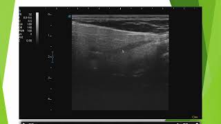 Echographie de la parotide le piège [upl. by Schuyler]