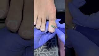 Pedicure transformation nailcare nailtreatment nails pedicure [upl. by Haidabez]