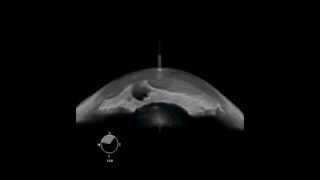 Peripheral Anterior Synechia in Glaucoma shown on OCT [upl. by Campagna]