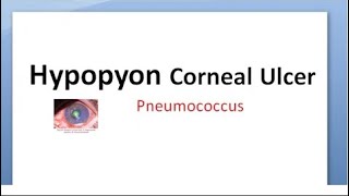 Ophthalmology 112 b Hypopyon Corneal Ulcer Strepcococcus pneumoniae Pneumococcus ulcus serpens [upl. by Yardley]