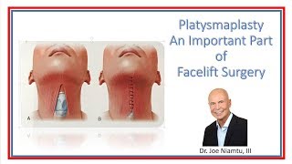 Platysmaplasty A most Important Part of a Facelift [upl. by Oirrad145]