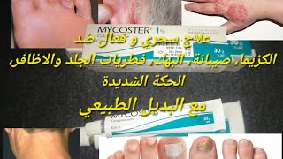 كريم فعال لعلاج فطريات الجلد والأظافر، كزيما، صيبانة، الحكة والبهك ميكوستر Mycoster 1 مع بديل طبيعي [upl. by Domingo]