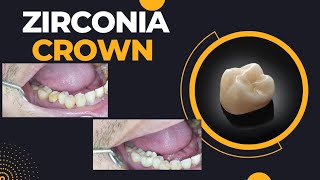 Zirconia crown cementation 🔥🔥🦷 [upl. by Notlef764]