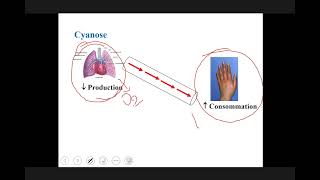 Cardiopathie congénitale [upl. by Kared]