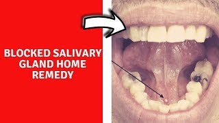 Salivary Gland Ablation  Treatment for Ranulas or Sialorrhea excessive drooling [upl. by Imtiaz]