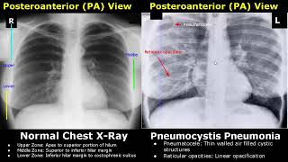 Chest XRay Lung Normal Vs Abnormal Image Appearances Part 1  TBPneumoniaConsolidationCollapse [upl. by Mada]