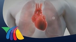 ¿Qué es la hipertensión pulmonar [upl. by Pacificas]