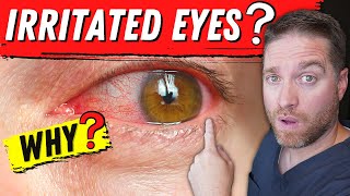 6 Top Causes Of IRRITATED EYES  Tips For Relief [upl. by Sommer]