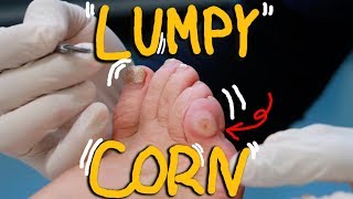 Satisfying Corn Removal with Callus HUGE LUMPY Corn [upl. by Fafa718]