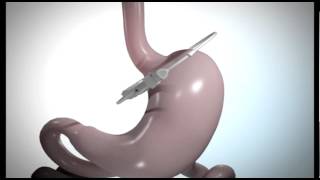 Bariatric Weight Loss  Laparoscopic Adjustable Gastric Band [upl. by Aitnahc]