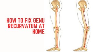 How to fix Genu RecurvatumHyperextended knee at home [upl. by Murielle]