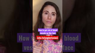 How to get rid of blood vessels on the face dermatologist [upl. by Laaspere]