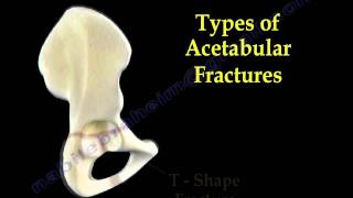 Acetabular Fractures  Everything You Need To Know  Dr Nabil Ebraheim [upl. by Helsell]