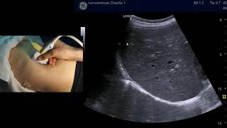 Sonographie der Leber systematische Durchmusterung [upl. by Eneloc]