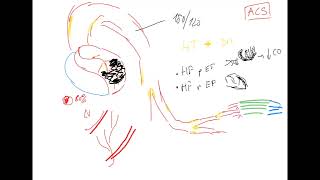 Interlinking pathophysiology part 3 heart failure lung edema pulmonary hypertension COPD OSA [upl. by Kellby]