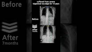 suffered from severe trigeminal neuralgia for 10 years  58 yo  Female  korea [upl. by Solegna]