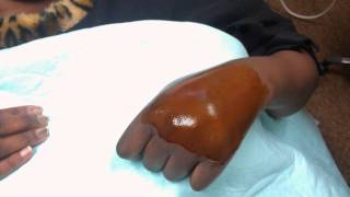 hand hematoma drainage [upl. by Enylecoj980]