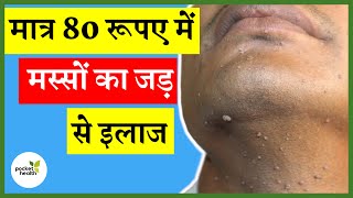 वारटोसिन दवाई का इस्तेमाल कैसे करें  How to Use Wartosin  Best Medicine For Wart Removal [upl. by Sidney939]