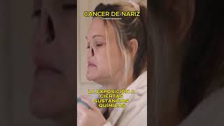 CANCER DE NARIZ [upl. by Jeanne]