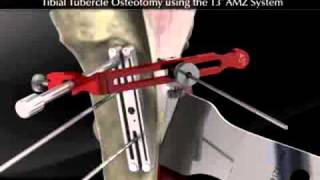 Tibial Tubercle Osteotomy using the T3 AMZ System [upl. by Erialcyram]